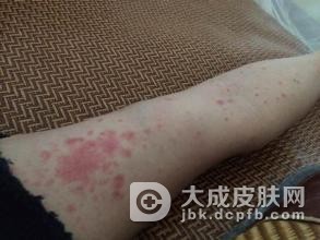 药疹的应对措施都有什么呢