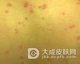 药疹疹型多千变万化