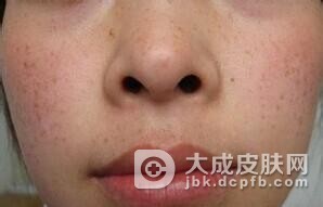 治疗黄褐斑的误区有哪些