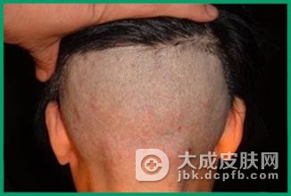 头癣会带来哪些危害呢