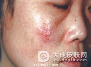 复发性生殖器疱疹有什么特征