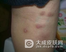 哪些部位易发疥疮结节呢