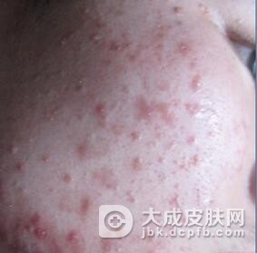 痤疮患者在饮食上应该注意什么呢