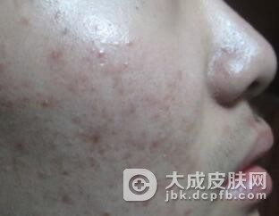 得了痤疮的患者日常注意哪些事项
