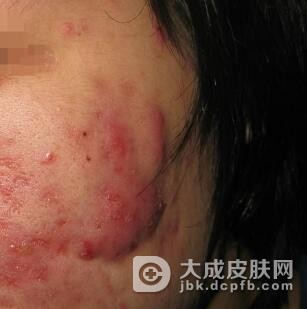 面部痤疮会传染吗