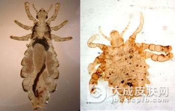 导致阴虱的原因有哪些