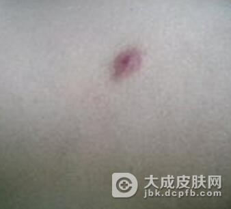 皮肤瘙痒症如何自我护理呢