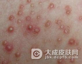 阴虱病是性病吗？