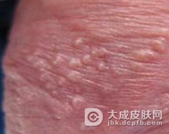 关于尖锐湿疣的饮食疗法有哪些