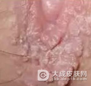生活中如何避免被尖锐湿疣感染
