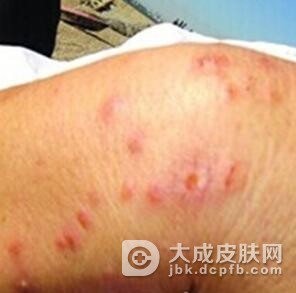 如果患上尖锐湿疣是什么样的