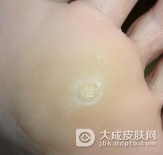 如何做好鸡眼预防工作