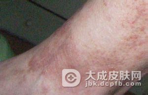 扁平苔藓到底要做好哪些护理?