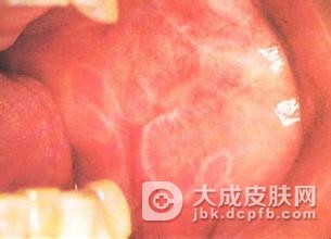 扁平苔藓的症状具体的都有什么呢?