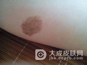 脸上有一块青的是青胎记吗