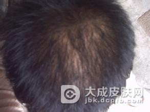 男性脱发该吃什么
