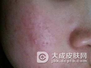 遗传过敏性皮炎有哪些症状
