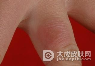 冬季预防冻疮的方法