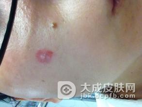 得了寻常疣要怎么治