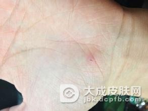 寻常疣的危害有哪些