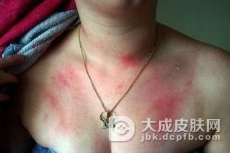急性荨麻疹与慢性荨麻疹有什么区别呢