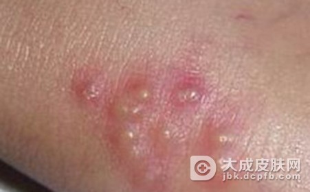 水痘症状的产生跟什么因素有关