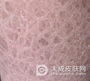 是什么因素诱发的鱼鳞病疾病