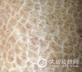 怎样才能治好鱼鳞病呢