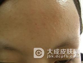 患上聚合性痤疮平时如何护理