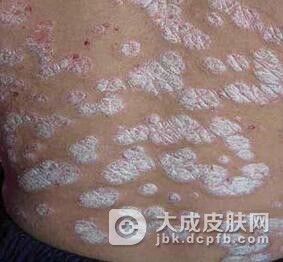 牛皮癣护理要注意哪些方面