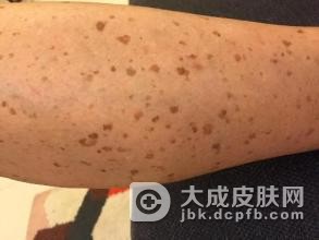 专家提醒：老年斑与年龄无关！