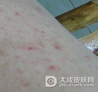 过敏性皮炎用什么药