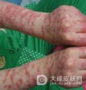 怎样预防系统性红斑狼疮的发生