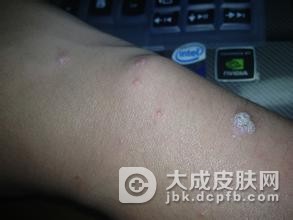 结节性痒疹是如何产生的
