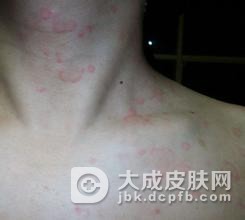 结节性痒疹的发病原理是什么