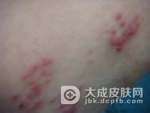 带状疱疹的治疗会有哪些误区