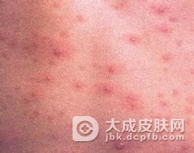 带状疱疹给健康造成的伤害