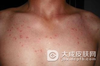 引发带状疱疹的有哪些原因