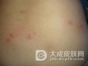 引起慢性荨麻疹的九大病因