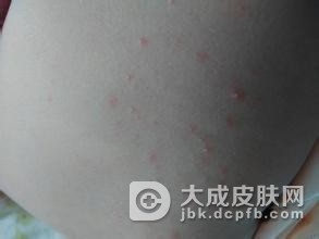 痱子可以用食疗方法吗