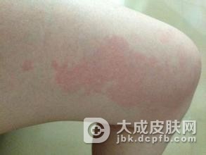 红斑狼疮怎么调养比较有效呢