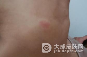 系统性红斑狼疮治疗需要注意十大事项