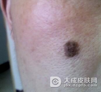 得了黑色素瘤如何治