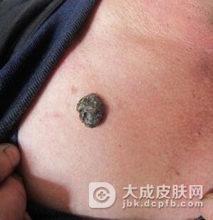 恶性黑色素瘤早期会有哪些症状呢
