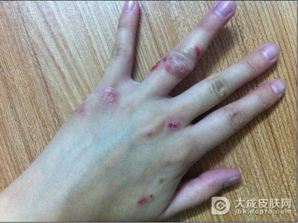 湿疹患者护理重点