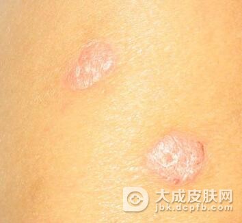 头部出现牛皮癣该怎么办呢