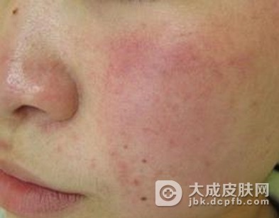 酒渣鼻具有哪些症状