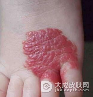 蔓状血管瘤是如何发生的