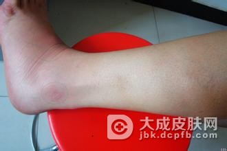 得了结节性红斑该怎么办