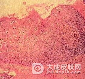 采用什么药物治疗尖锐湿疣好呢